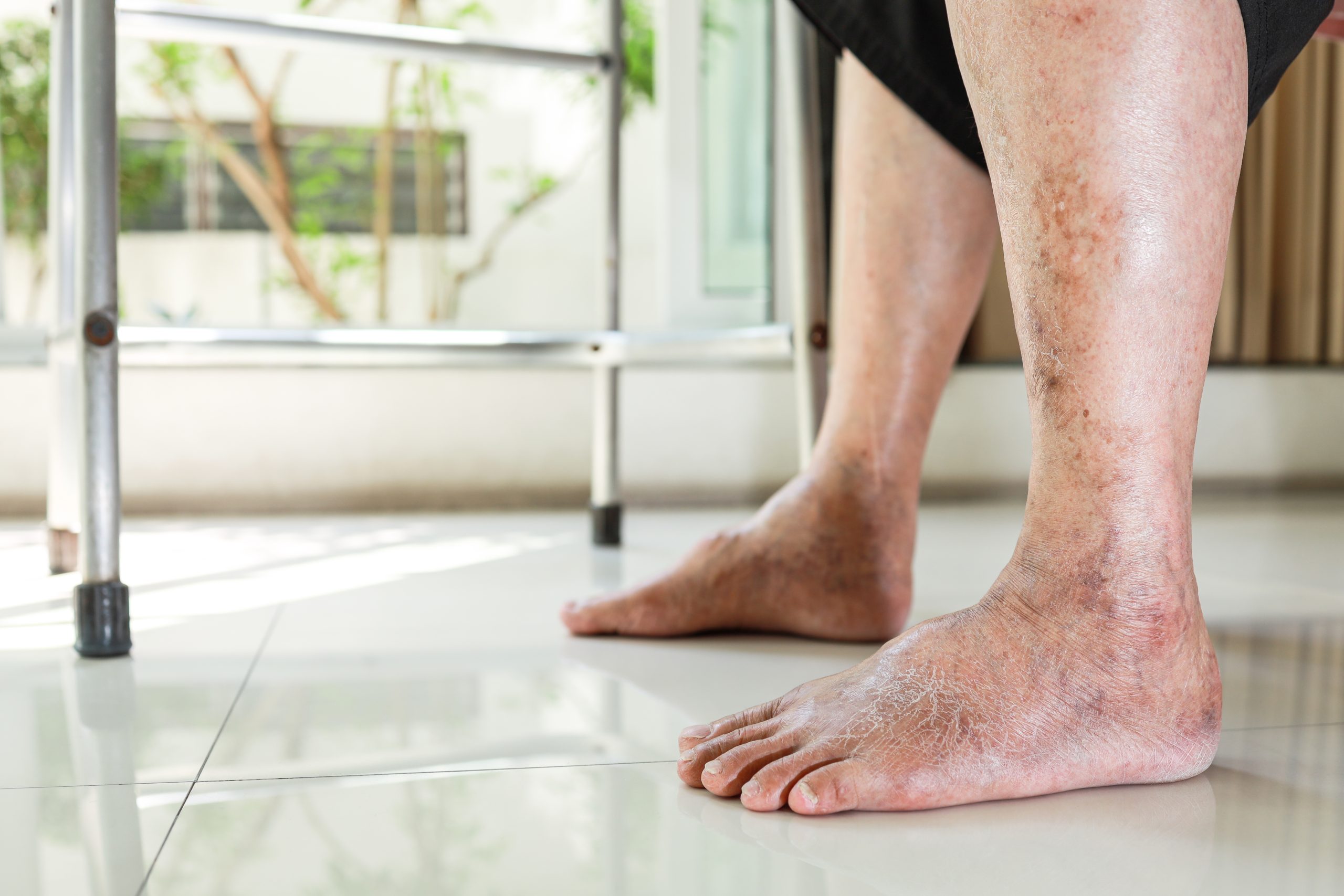 Wound Infection